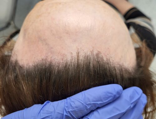 Jizvící alopecie u mužů a u žen